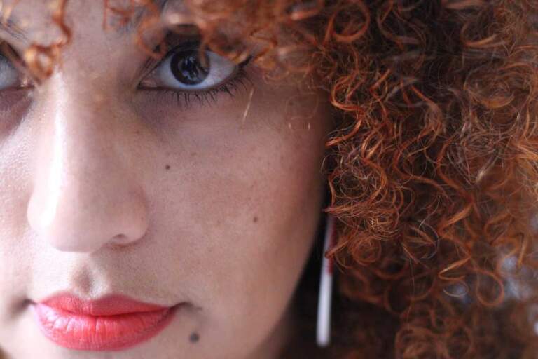 Does Melasma Require Ongoing Care Rather Than One Treatment?