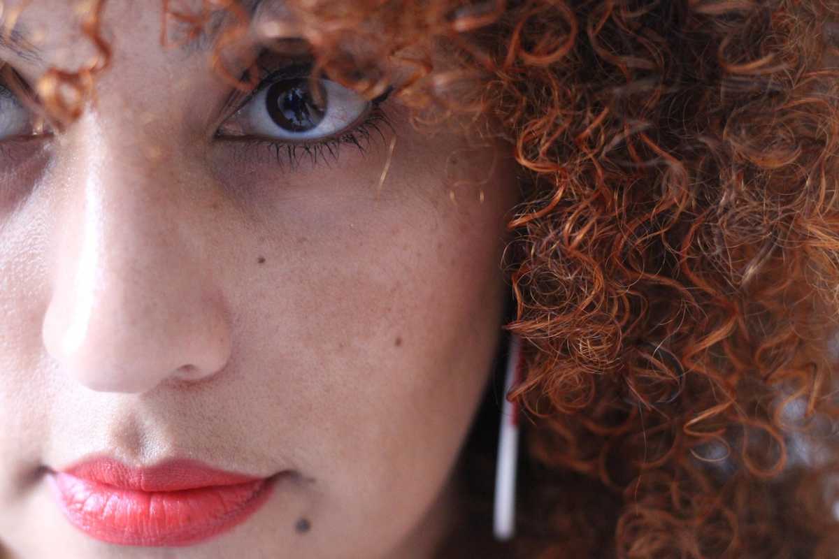 Does Melasma Require Ongoing Care Rather Than One Treatment?