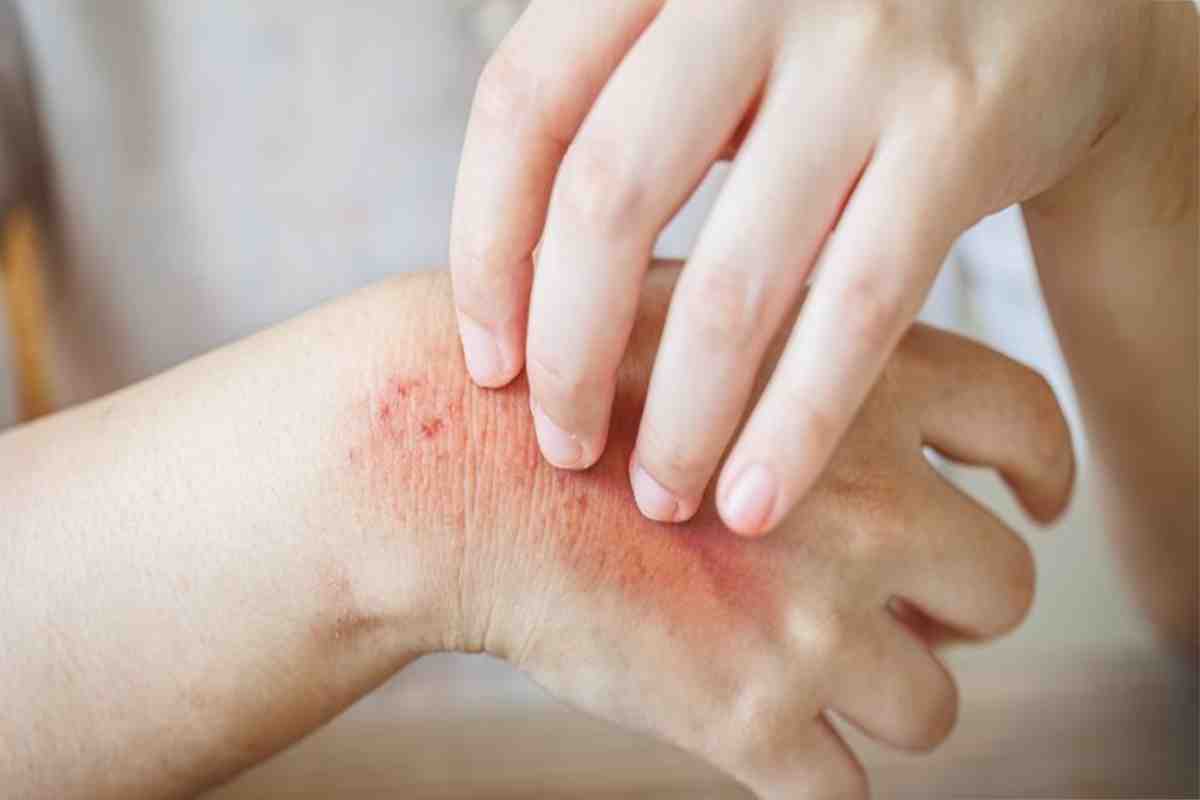 Treating Skin Conditions Naturally with Chinese Herbs